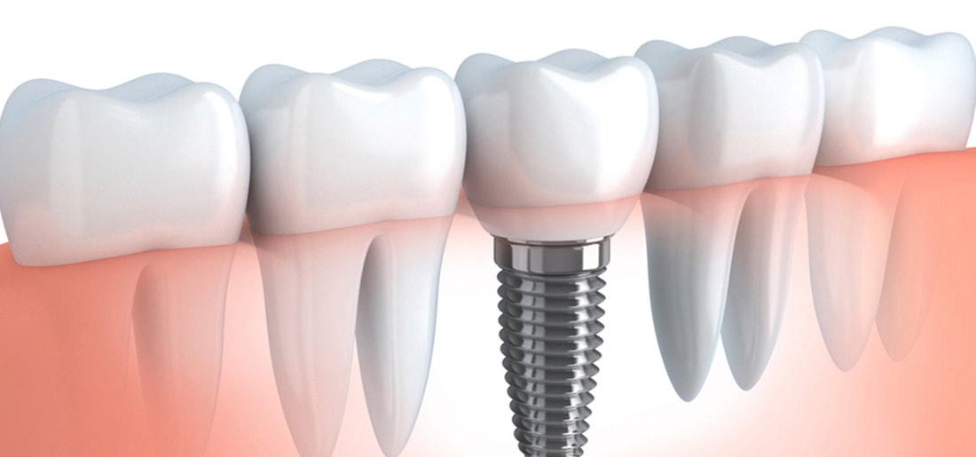 Dental Implants a permanent way to fill the gaps in your mouth due to missing teeth.