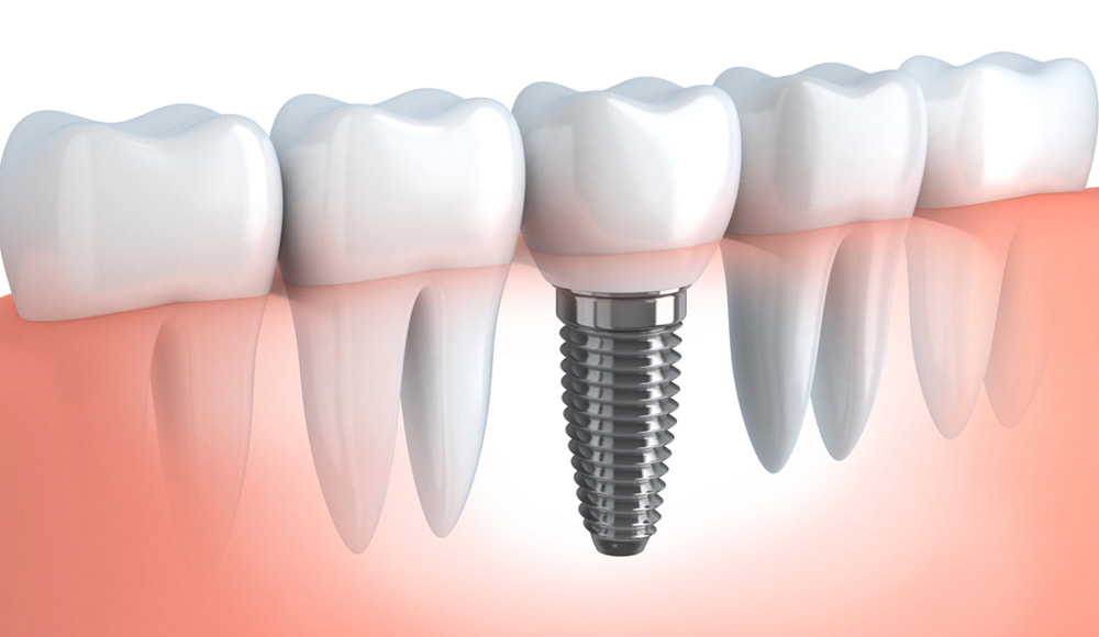 Dental Implants treatment for missing tooth.