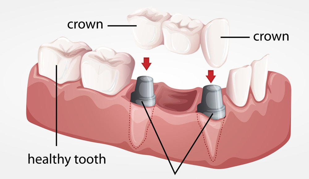 Showing implant process illustration.