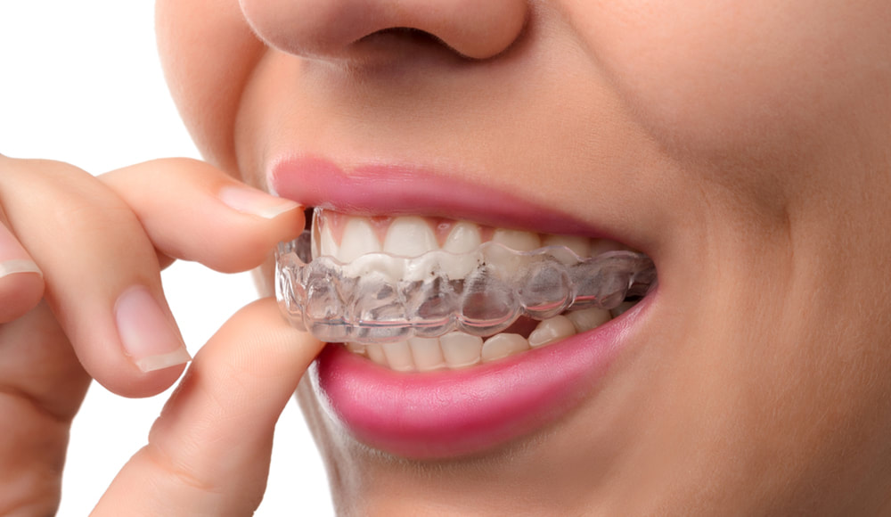 Invisalign Treatment for young, teens and adults.