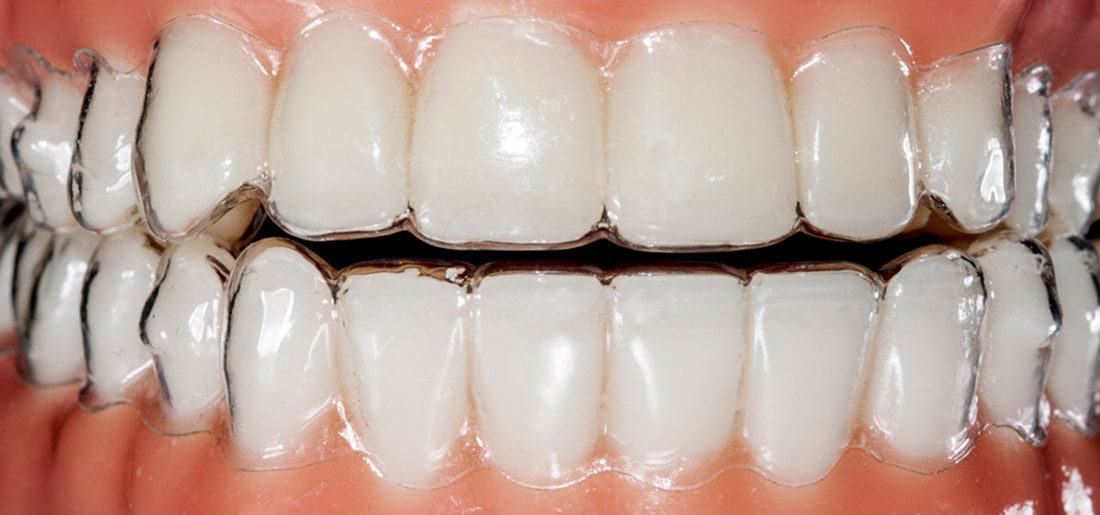 Invisalign treatment for an innovative and pain-free way to straingthen teeth.