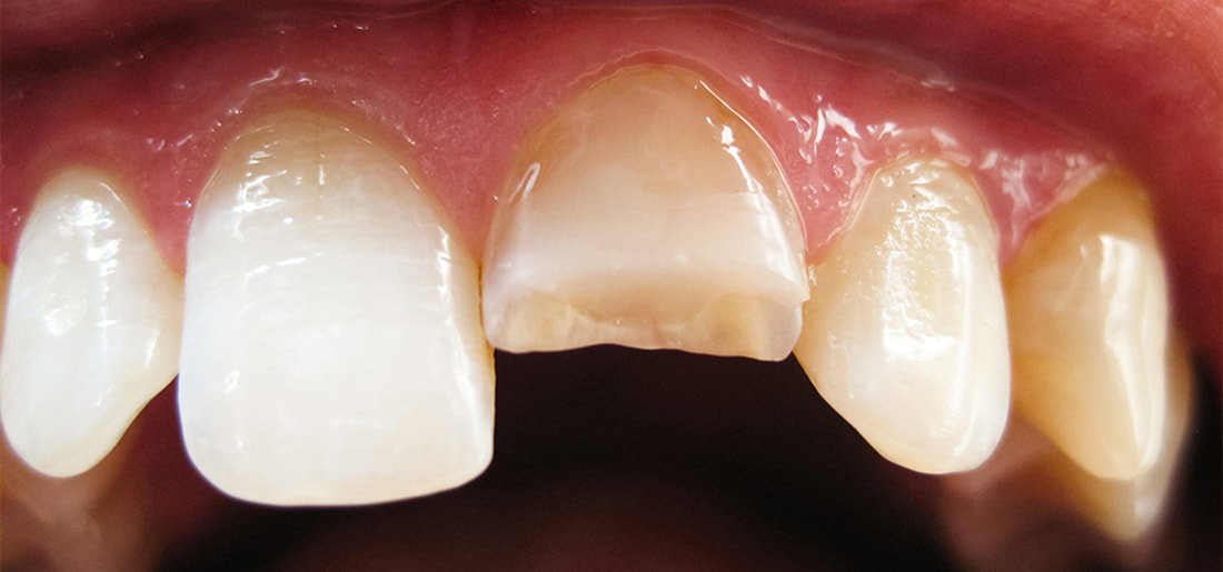 Teeth with severely cracked, chipped teeth.