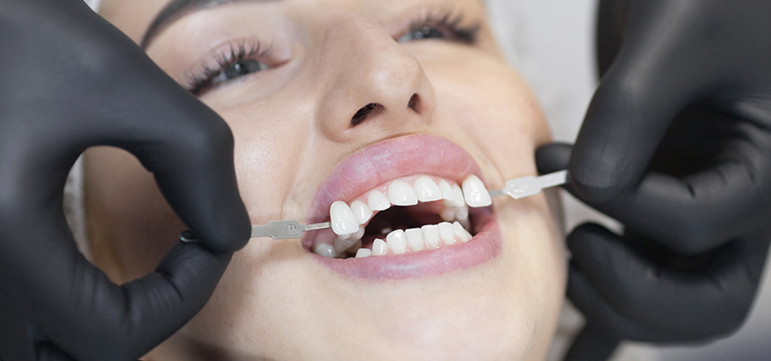 Dentist showing veneers to female patient close similar to natural teeth.