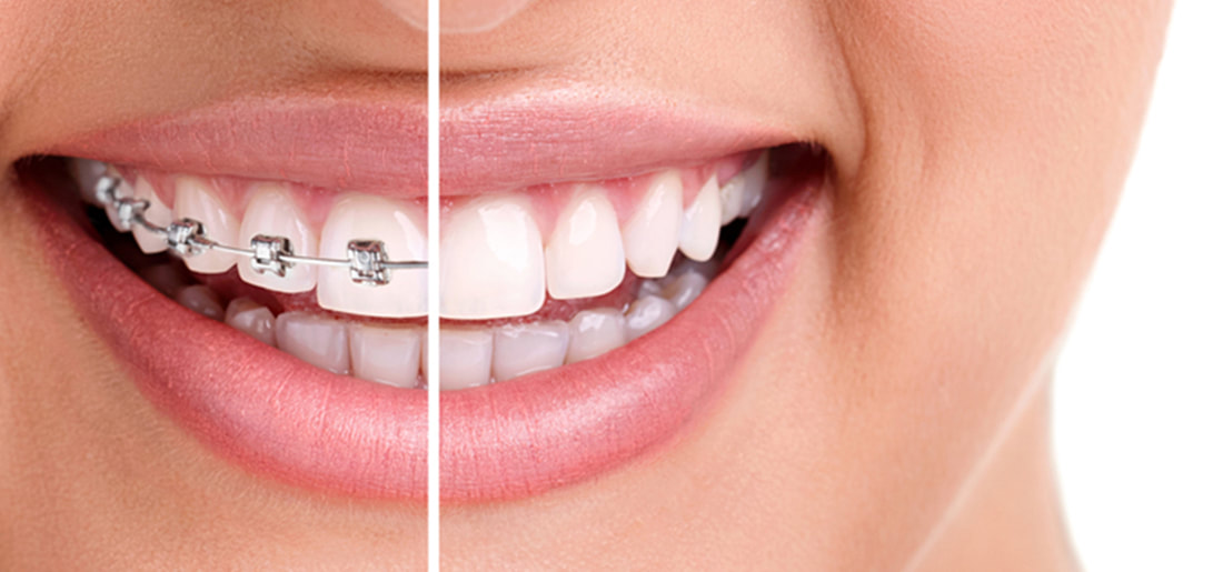 Before and after whitening teeth at Dentist North Brisbane.