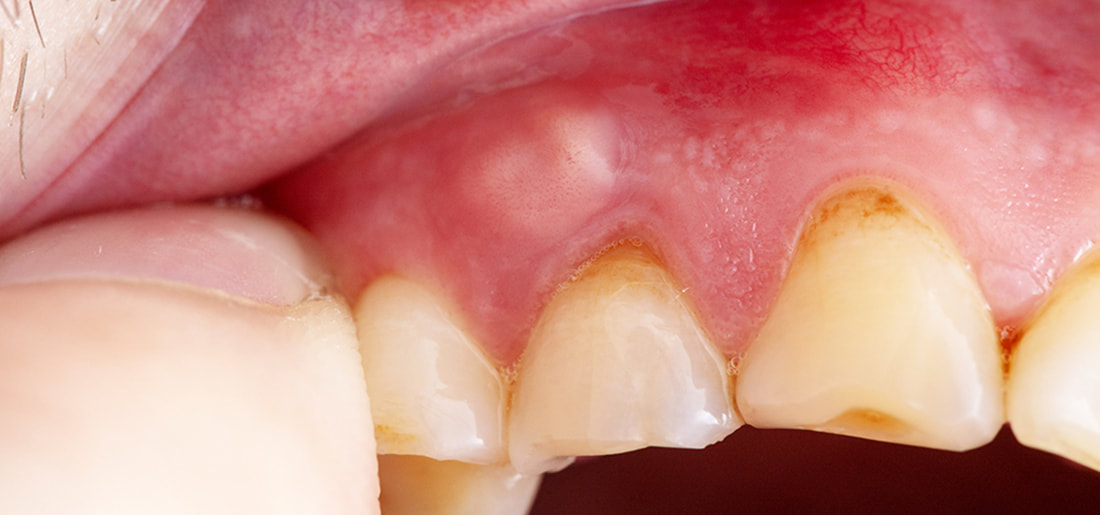 Person with tooth and gum abscess